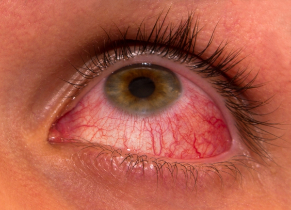 Синдром сухих глаз: причины и методы борьбы