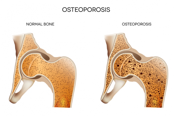 Диета против остеопороза